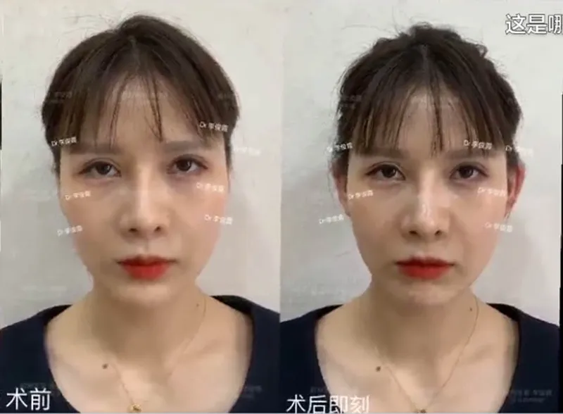A Chinese woman's before and after plastic surgery photos showing modifications to her ears